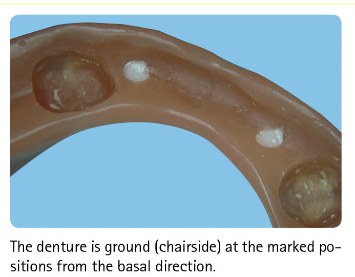 Bredent Retention.Sil 200, 400, 600, 1pc Impulsedent Australia