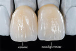 Bredent novo.lign Veneers Teeth – Upper anterior H46, 6er