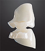 Bredent novo.lign Veneers Teeth – Upper posterior W5, Q1 right upper