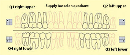 Bredent novo.lign Veneers Teeth – Upper posterior W3, Q1 right upper