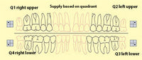 Bredent novo.lign Veneers Teeth – Upper posterior G4, Q1 right upper
