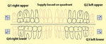 Bredent novo.lign Veneers Teeth – Lower posterior W5, Q4 right lower