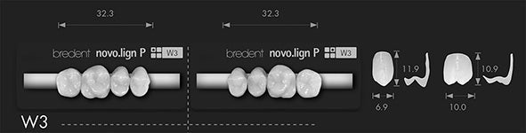 Bredent novo.lign Veneers Teeth – Upper posterior W3, Q2 left upper