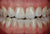Creation TD / Transition Dentine Basic porcelains, Kit